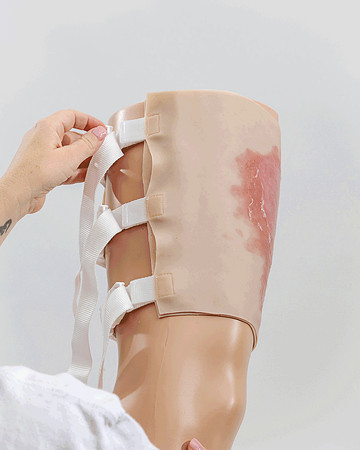 ts-250805-upper-leg-scald