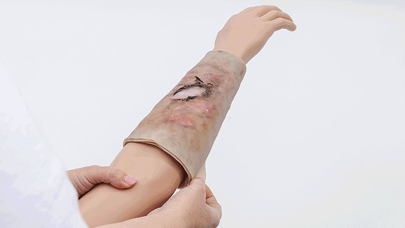ts-250805-forearm-burn-progression